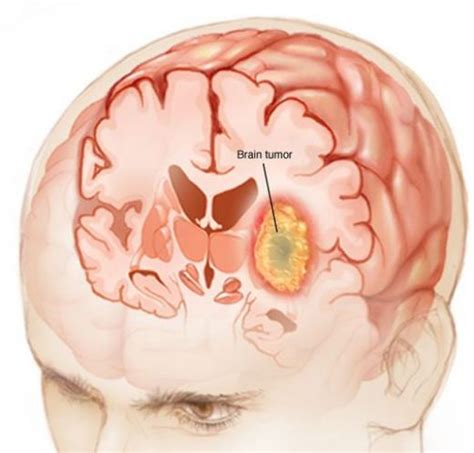 Beyin tümörü grade 4